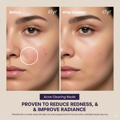 LED Skin Rejuvenation Mask – Collagen Boost & Acne Care